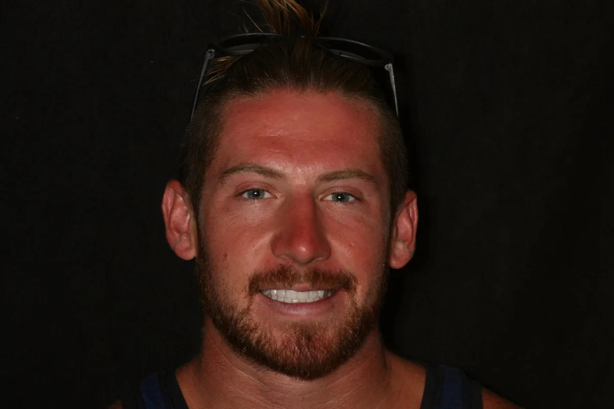 After, 16 Porcelain Veneers: Jon