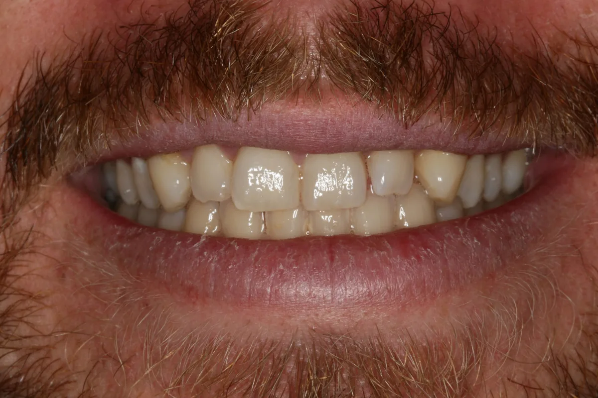 Before (close-up), 16 Porcelain Veneers: Jon