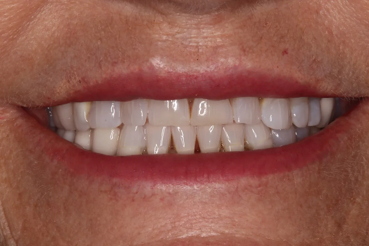 Before (close-up), 14 Veneers + 4 Porcelain Crowns: Kelly