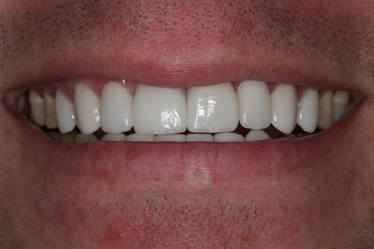 After (close-up), 14 Porcelain Veneers: Kenny