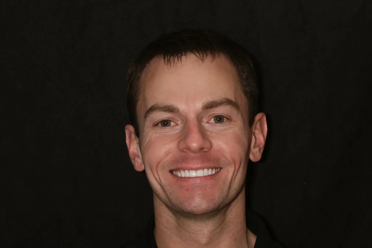 After, 14 Porcelain Veneers: Kenny