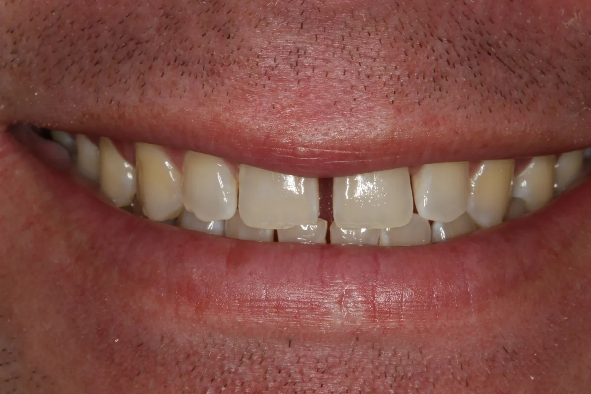 Before (close-up), 14 Porcelain Veneers: Kenny