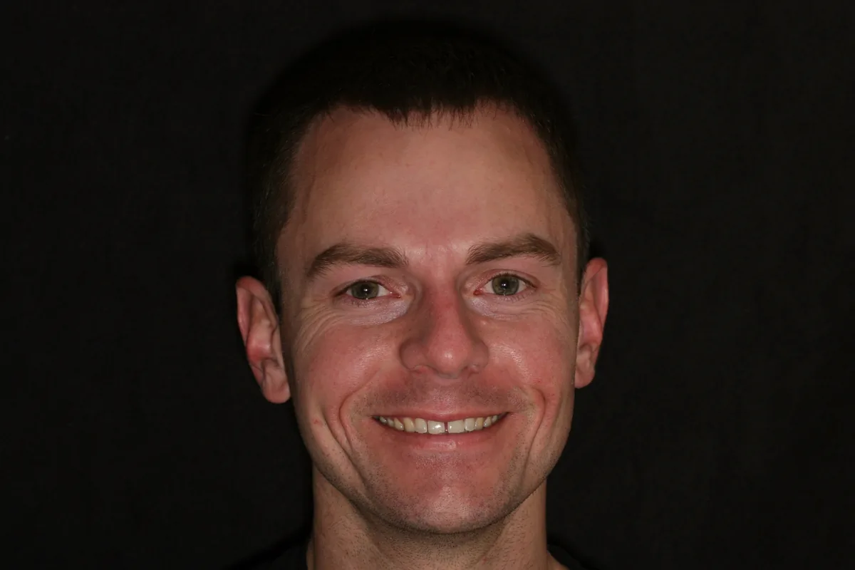 Before, 14 Porcelain Veneers: Kenny