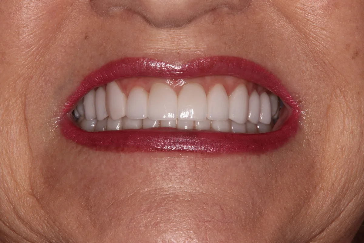 After (close-up), 18 Porcelain Veneers: Lynette