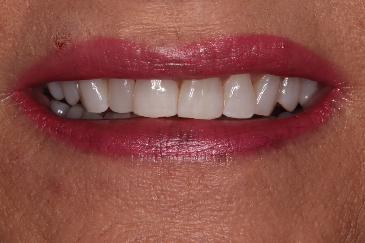 Before (close-up), 18 Porcelain Veneers: Lynette