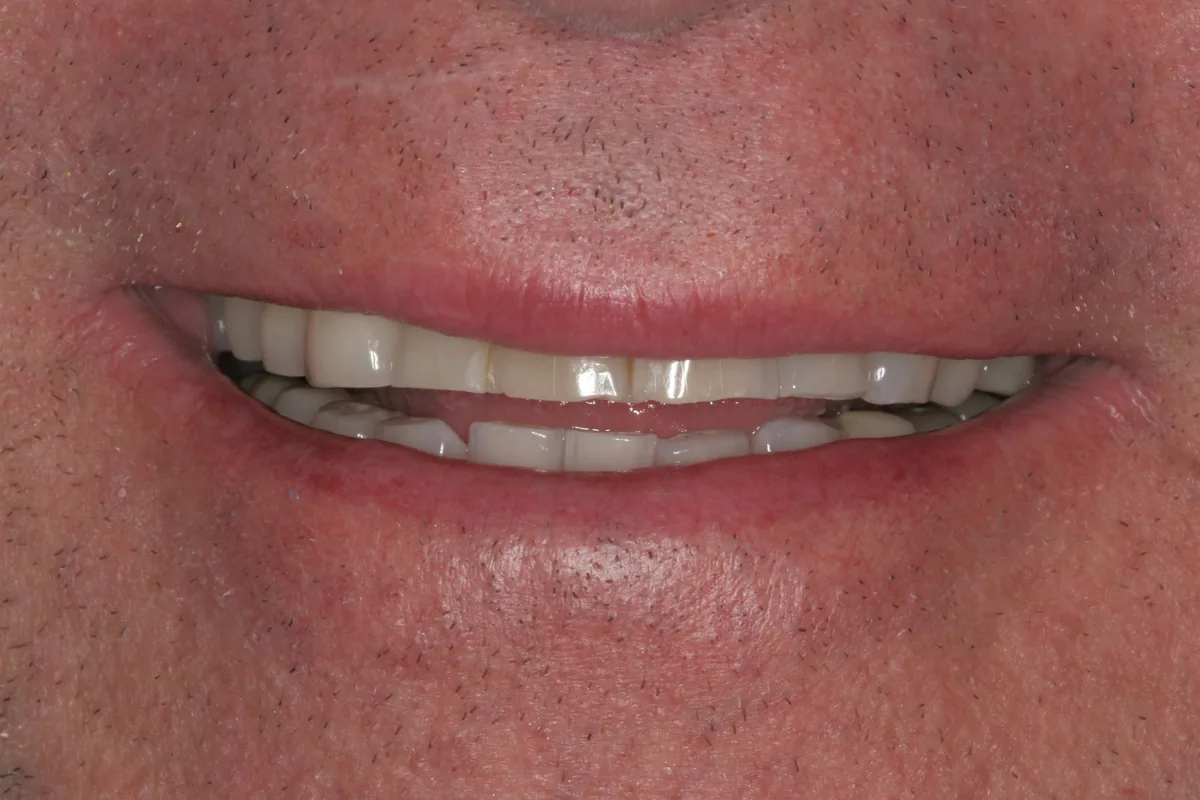 Before (close-up), 18 Esthetic Crowns: Mark