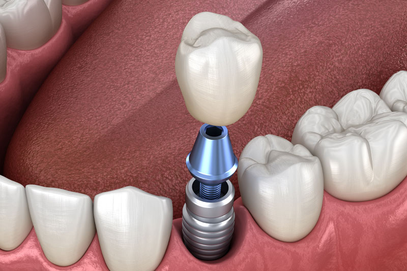 dental-implant-model-2