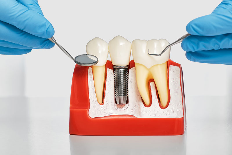 dental-implant-model-bone-cutaway-3