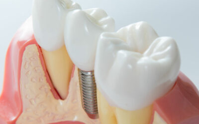 After Getting A Full Arch Of Teeth Extracted, Should I Get Treated With Full Mouth Dental Implants?