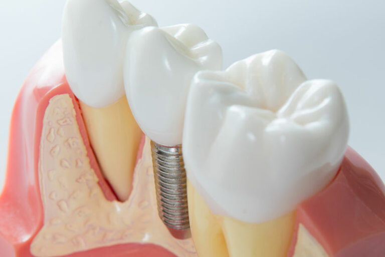 dental-implant-post-digital-model