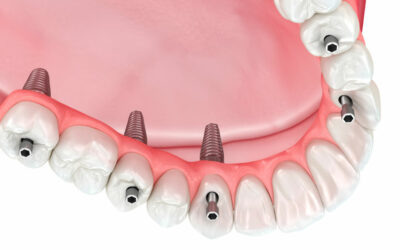 If I Don’t Get Dental Implants To Replace My Teeth, What Can Happen?