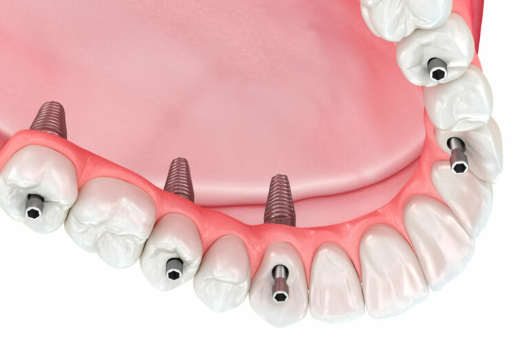 /dental-implant-prosthetic-being-placed-on-dental-implant-posts
