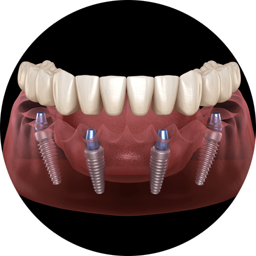 full-arch-dental-implants-4
