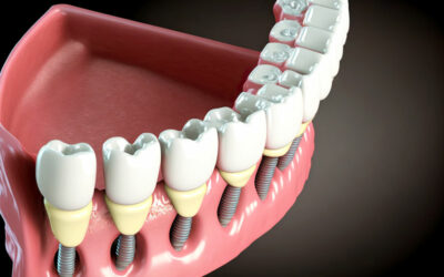 Are Dental Implants Able To Restore My Smile?