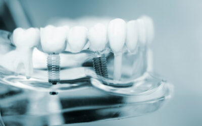 Although Every Person’s Smile Is Unique, What Does A Typical Multiple Dental Implant Procedure Look Like?