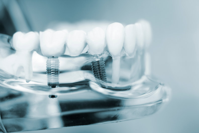 multiple-dental-implant-model