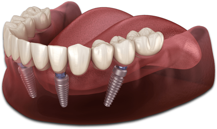 full-arch-dental-implants-model