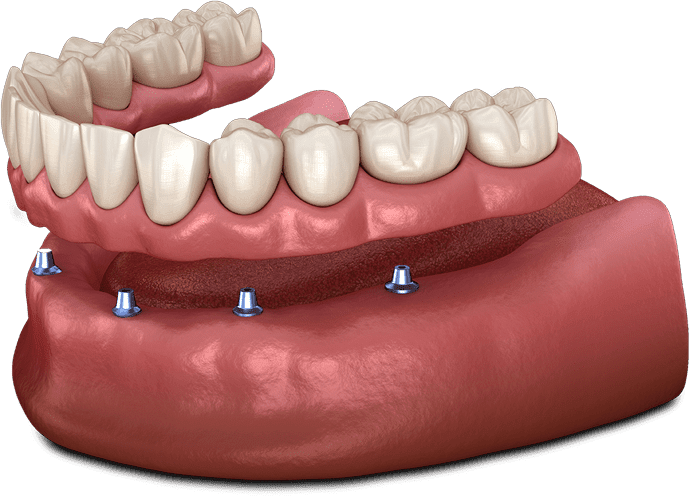 implant-supported-dentures-model