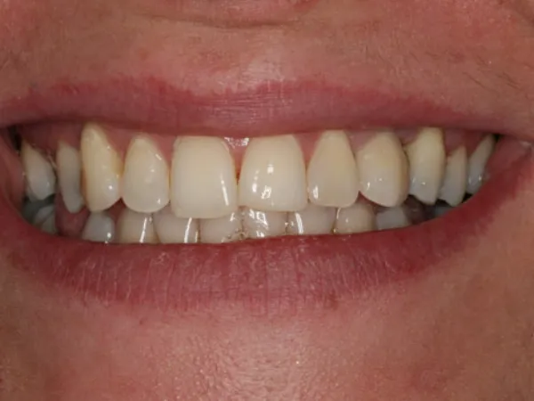 Single Dental Implants After