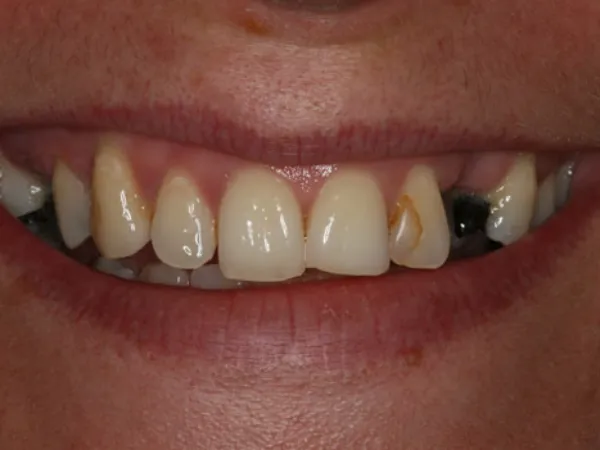 Single Dental Implants Before