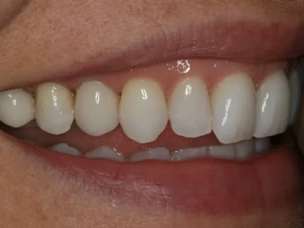 Single Dental Implants After