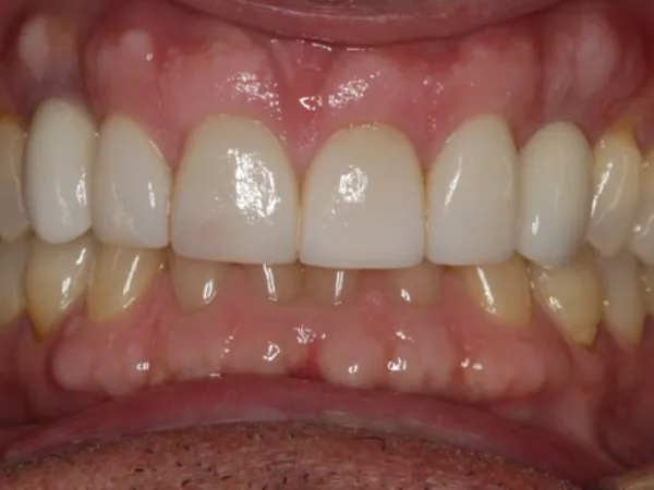 Single Dental Implants After