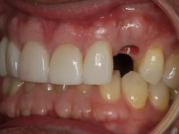 Single Dental Implants Before