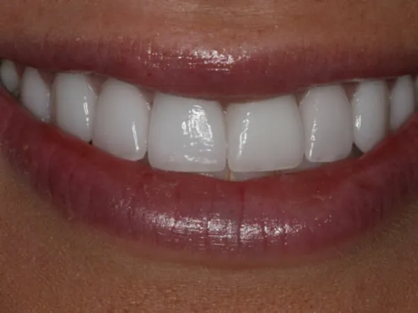 Porcelain Veneers After
