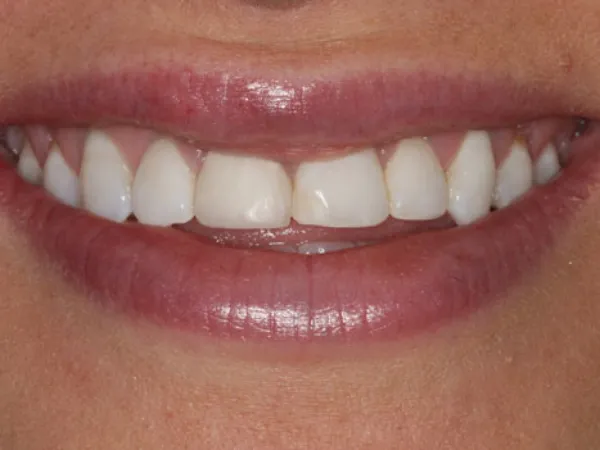 Porcelain Veneers Before