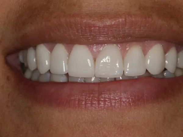 Porcelain Veneers After