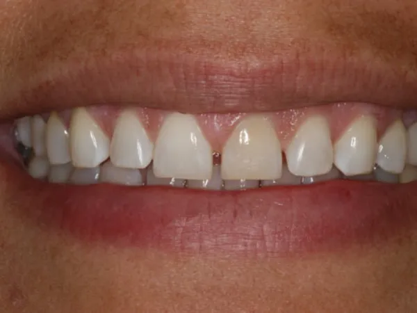 Porcelain Veneers Before