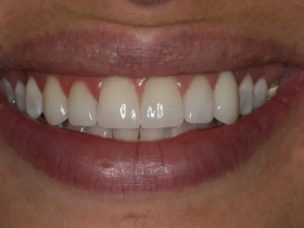 Porcelain Veneers After