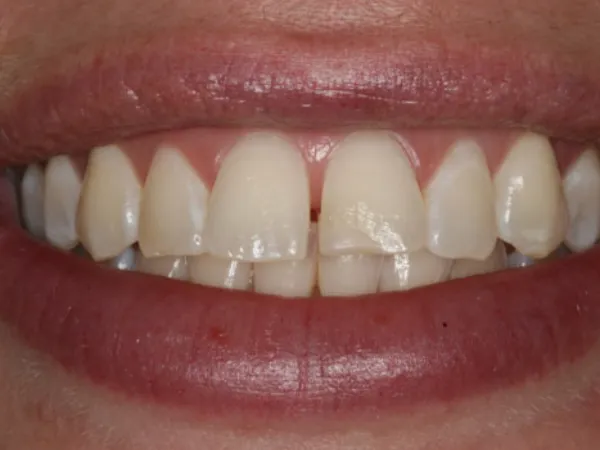 Porcelain Veneers Before