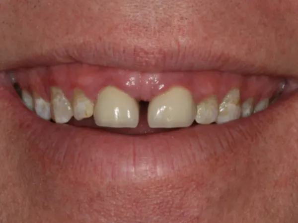 Porcelain Veneers Before