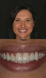 dental veneers before and after in slc kristy after