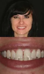 dental veneers before and after in slc kristy before