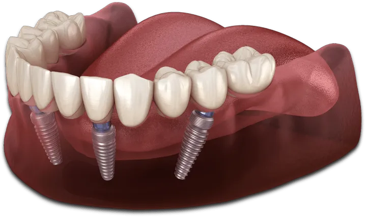 Locator Dentures