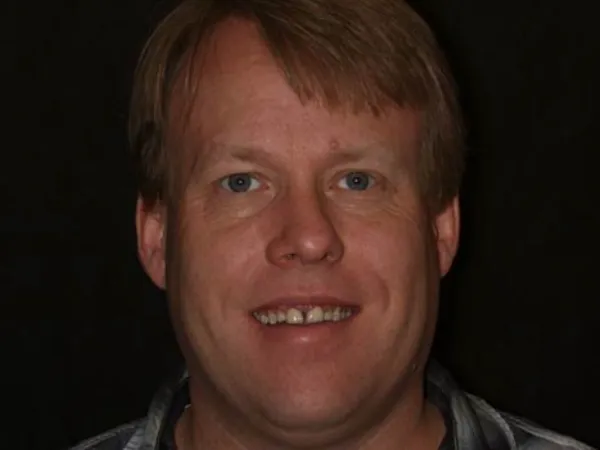 Gum Reshaping Before