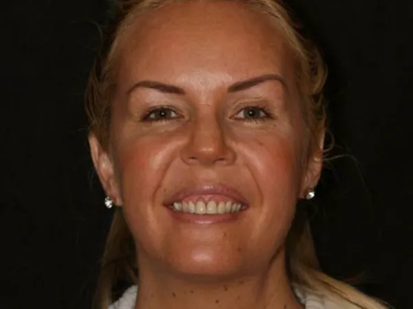 Gum Reshaping Before