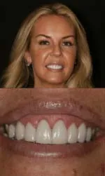 gummy smile before and after tiffin after