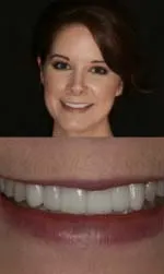 porcelain bridge and veneers before and after bridgitte after