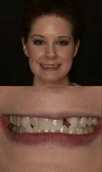 porcelain bridge and veneers before and after bridgitte before