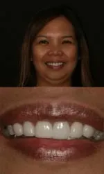 porcelain crowns before and after aileen after