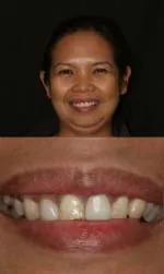 porcelain crowns before and after aileen before