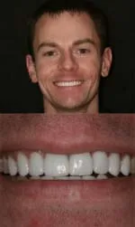 porcelain veneers before and after kenny after