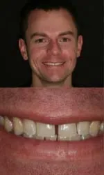 porcelain veneers before and after kenny before