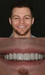 porcelain veneers before and after zach after