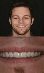 porcelain veneers before and after zach before