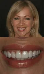 same day porcelain veneers before and after saria after