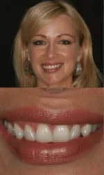 same day porcelain veneers before and after saria before